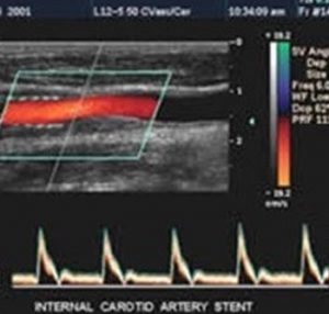 Vascular Sonograph